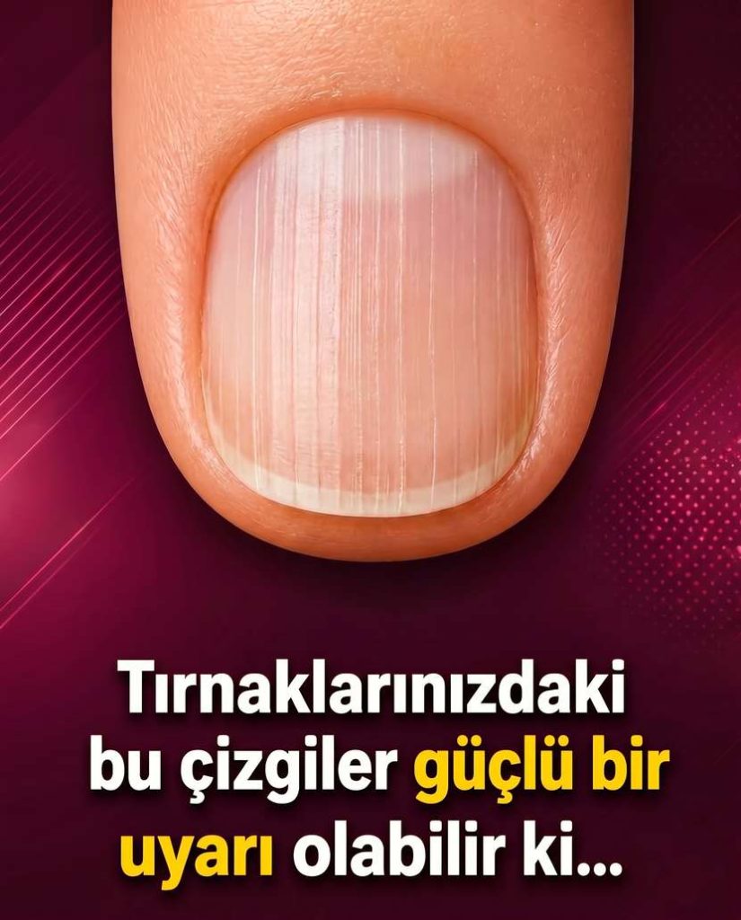 Tırnaklarınızdaki Dikey Çizgiler Size Ne Anlatıyor Olabilir? Özellikle 40 Yaşından Sonra - Fotoğraf 2